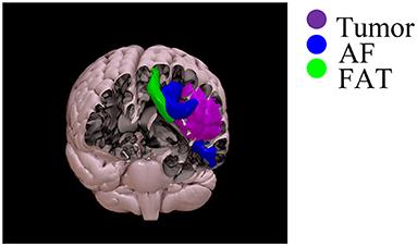 Neuroplasticity Mechanisms in Frontal Brain Gliomas: A Preliminary Study